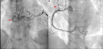 Case Report: Unusual Cause of Chest Pain: A Multi-Image Assessment of a Cardiac Mass